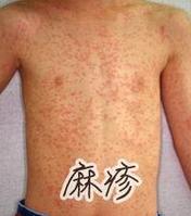 春季常见传染病防治手册
