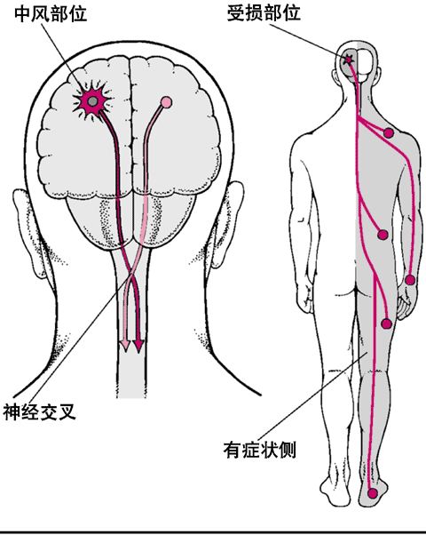 脑卒中的八种“先兆”